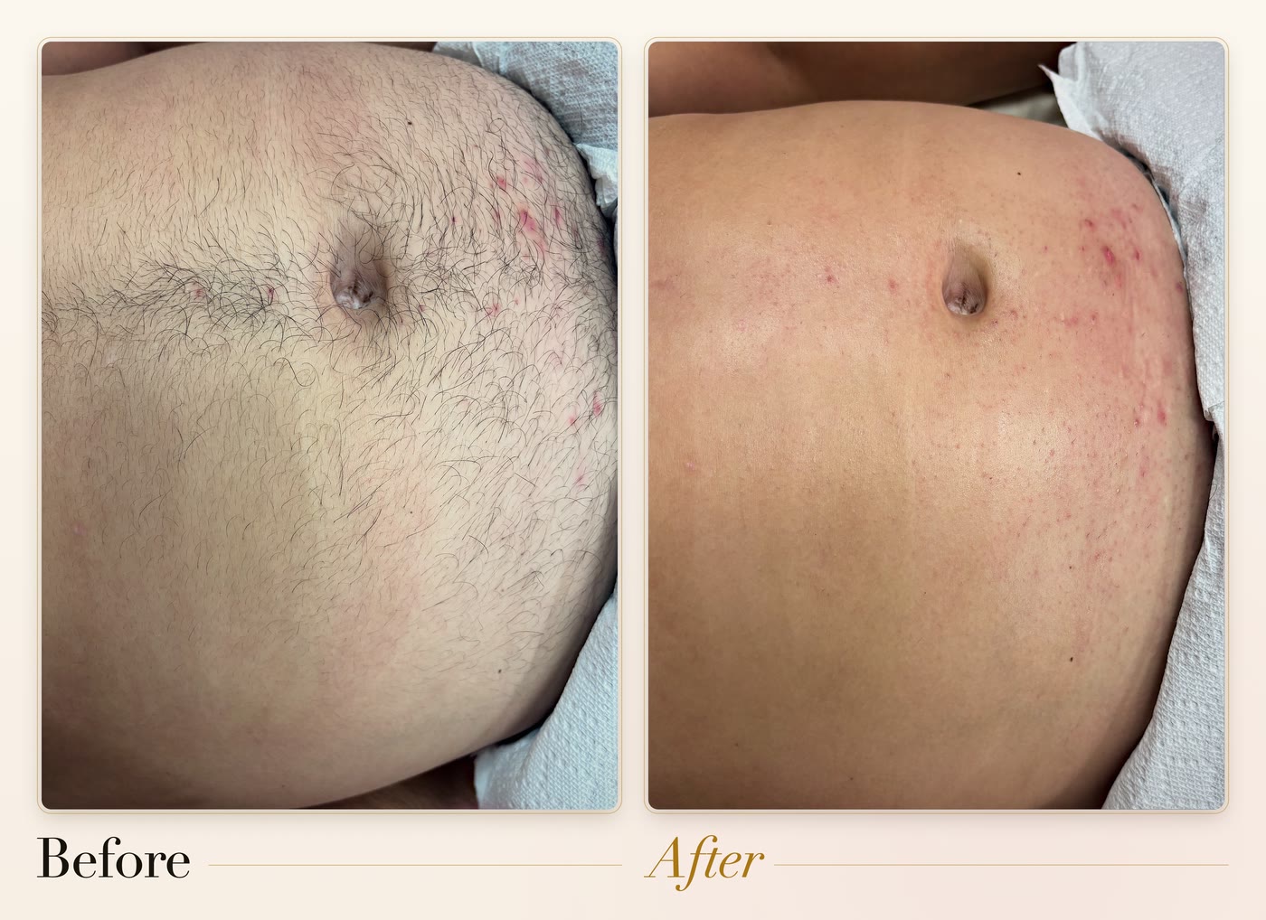 A stomach before and after waxing
